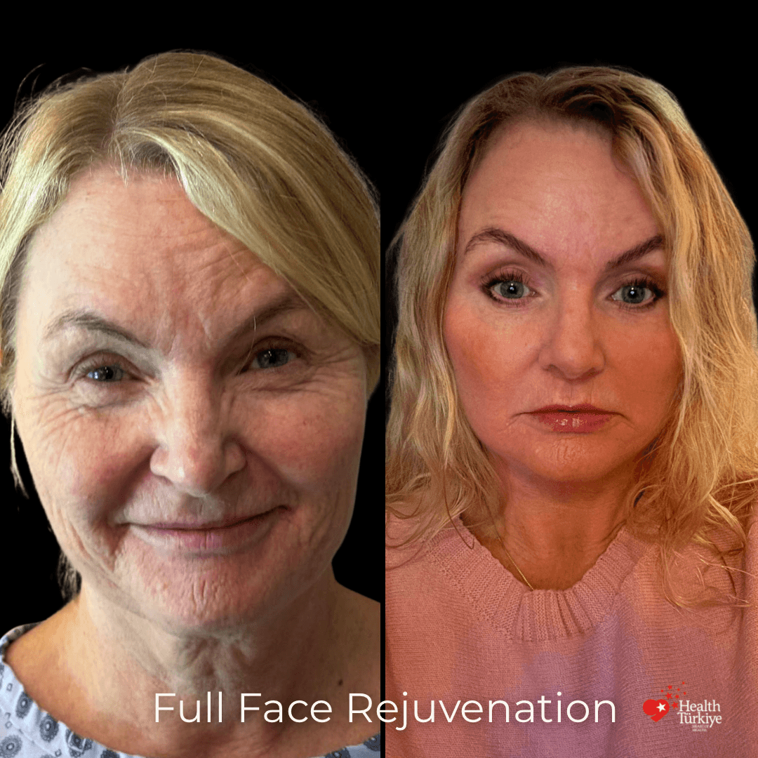 Before and after with Dr. Fatih Çınar: Full face rejuvenation