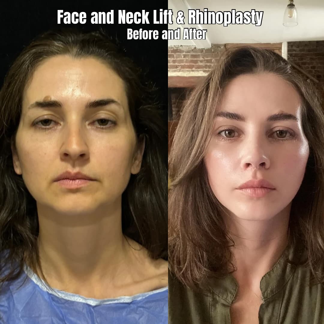Before and after with Dr. Fatih Çınar: Face and neck lift · rhinoplasty