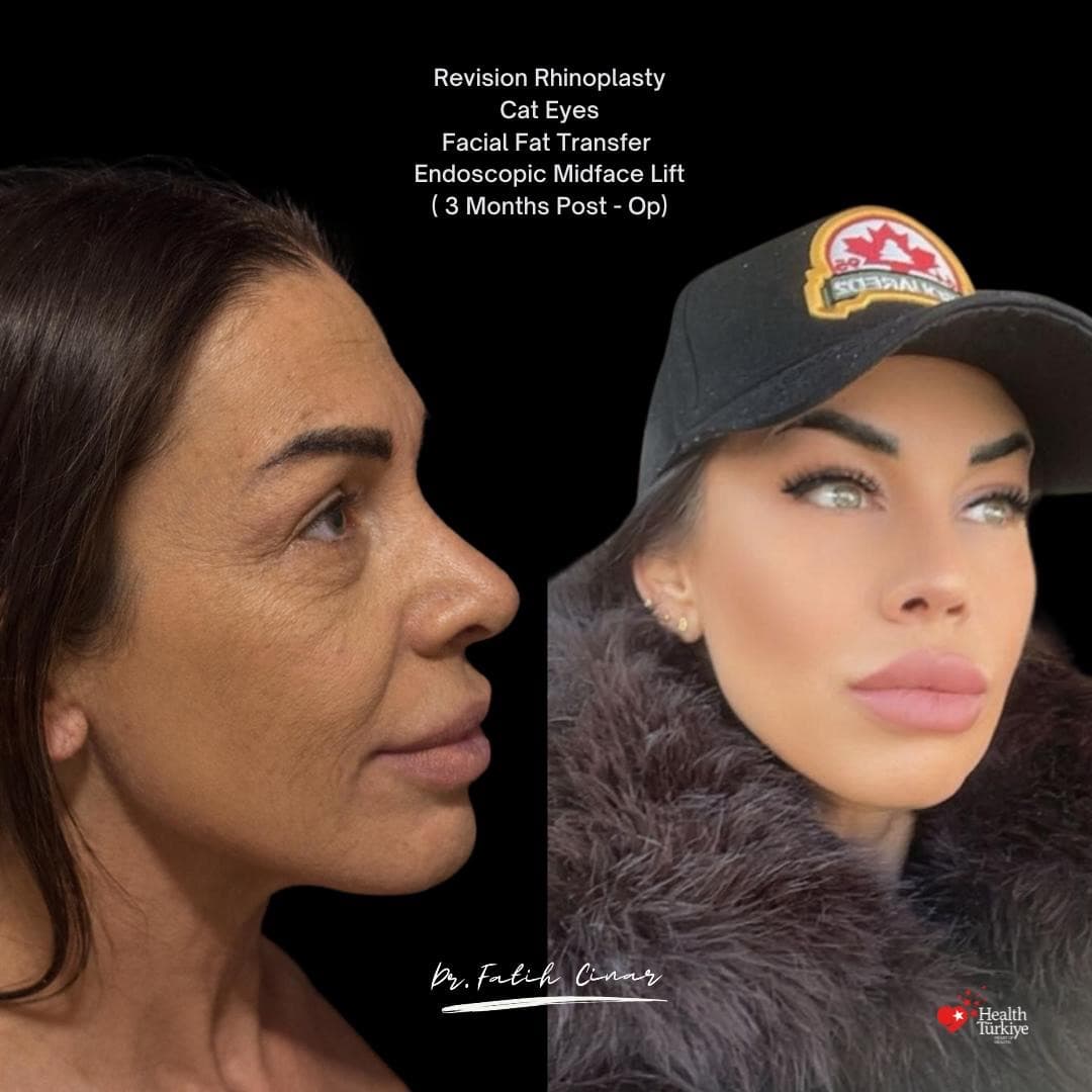 Before and after with Dr. Fatih Çınar: Midface lift · fat transfer · 3 months post-op