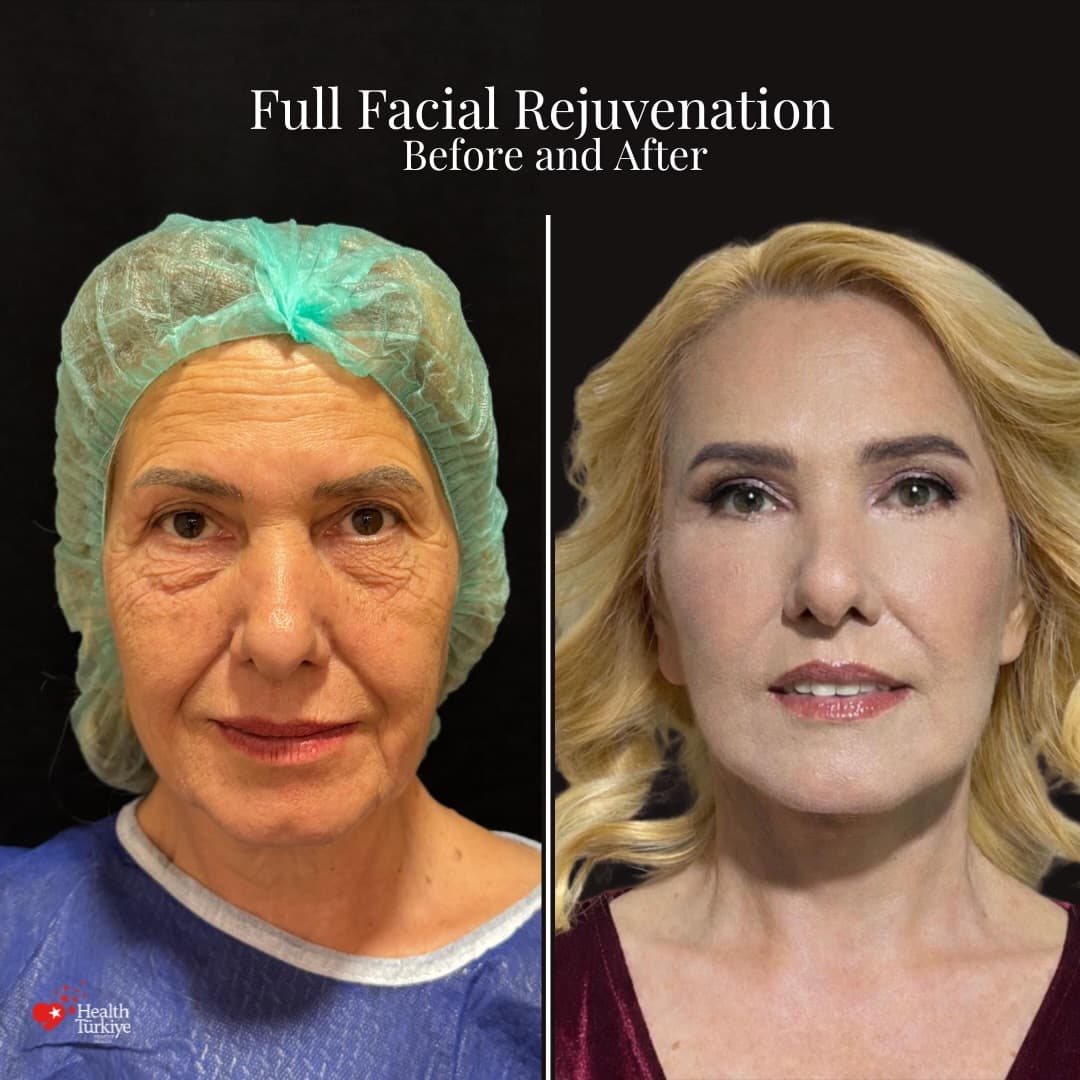 Before and after with Dr. Fatih Çınar: Full facial rejuvenation · deep plane