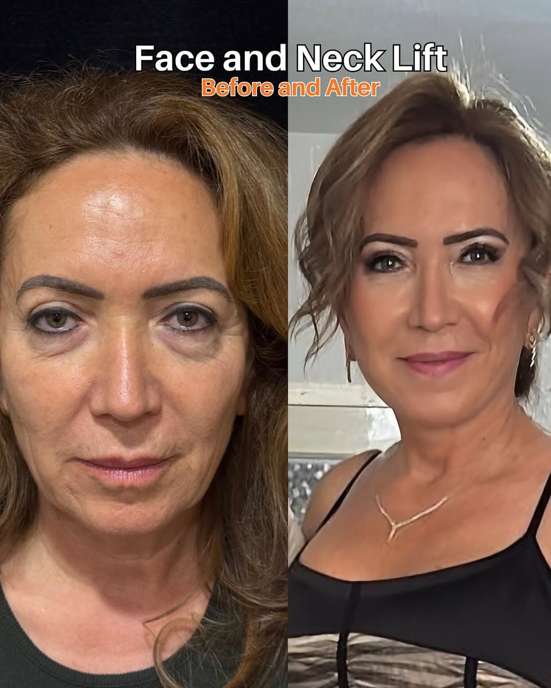 Before and after with Dr. Fatih Çınar: Face and neck lift