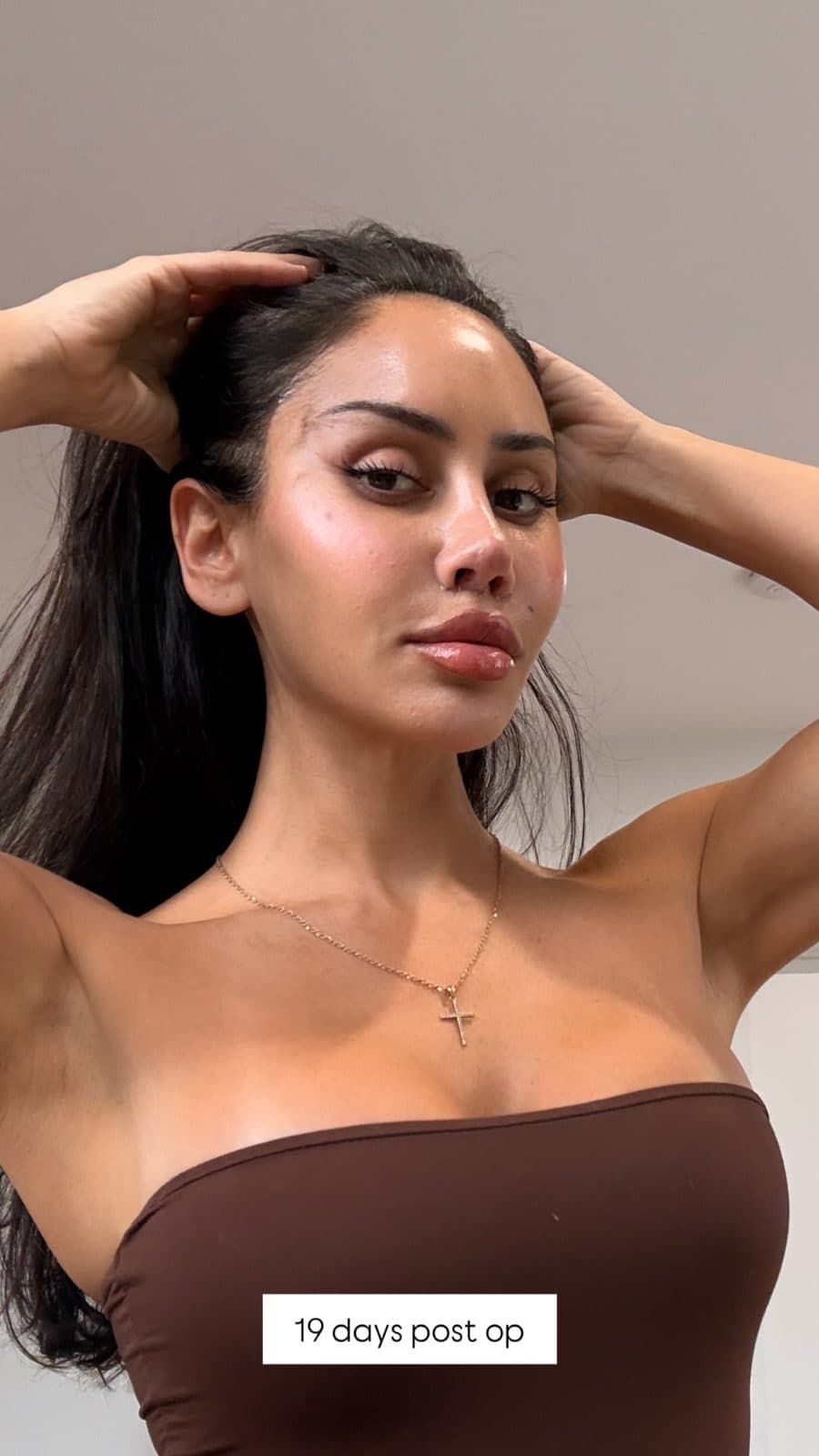 The patient 19 days after her facelift