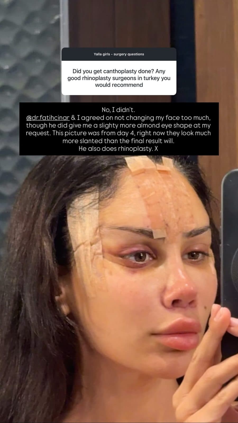 Patient Instagram story: Did you get canthoplasty done?