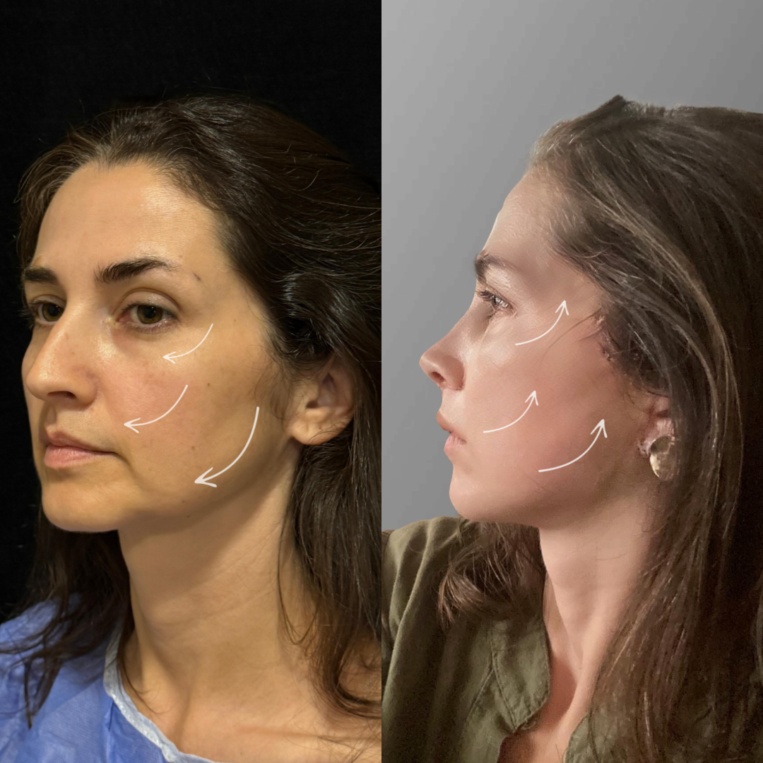 Face Lift